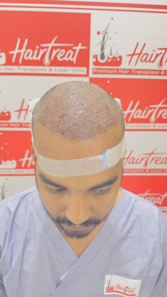 Hair transplant