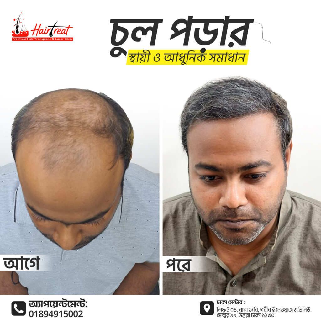 Hair transplant,